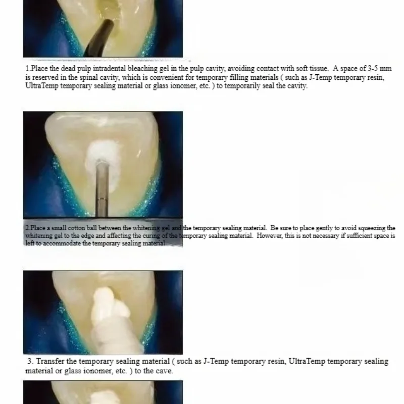 Материалы для восстановления п – обзор и цена Teeth Whitening Effects