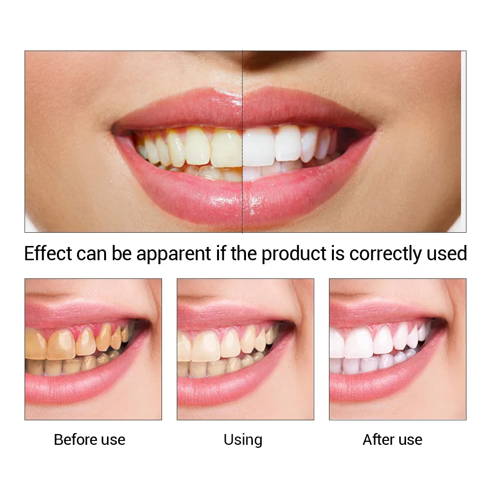 FTEENPLY отбеливание зубов быс – обзор и цена Teeth Whitening Street