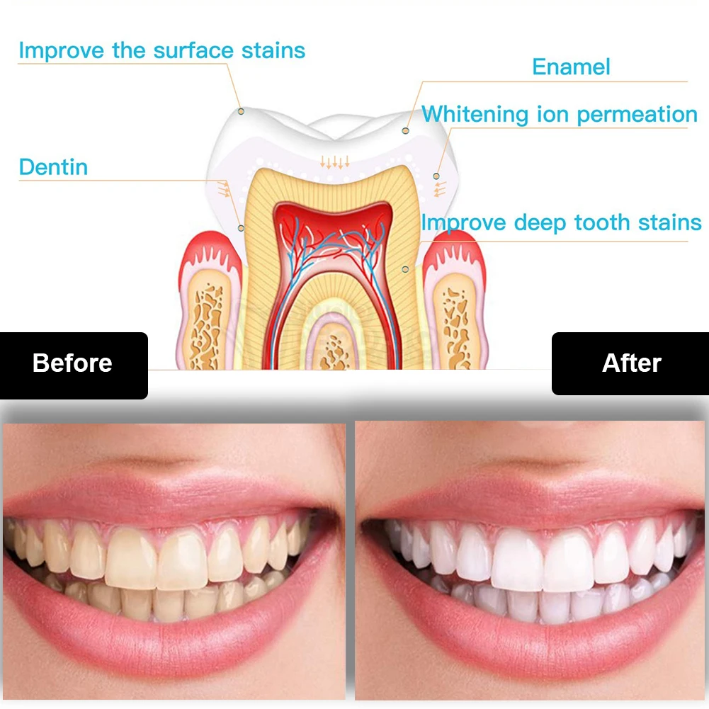 Набор для отбеливания зубов, м – обзор и цена Teeth Whitening Singapore