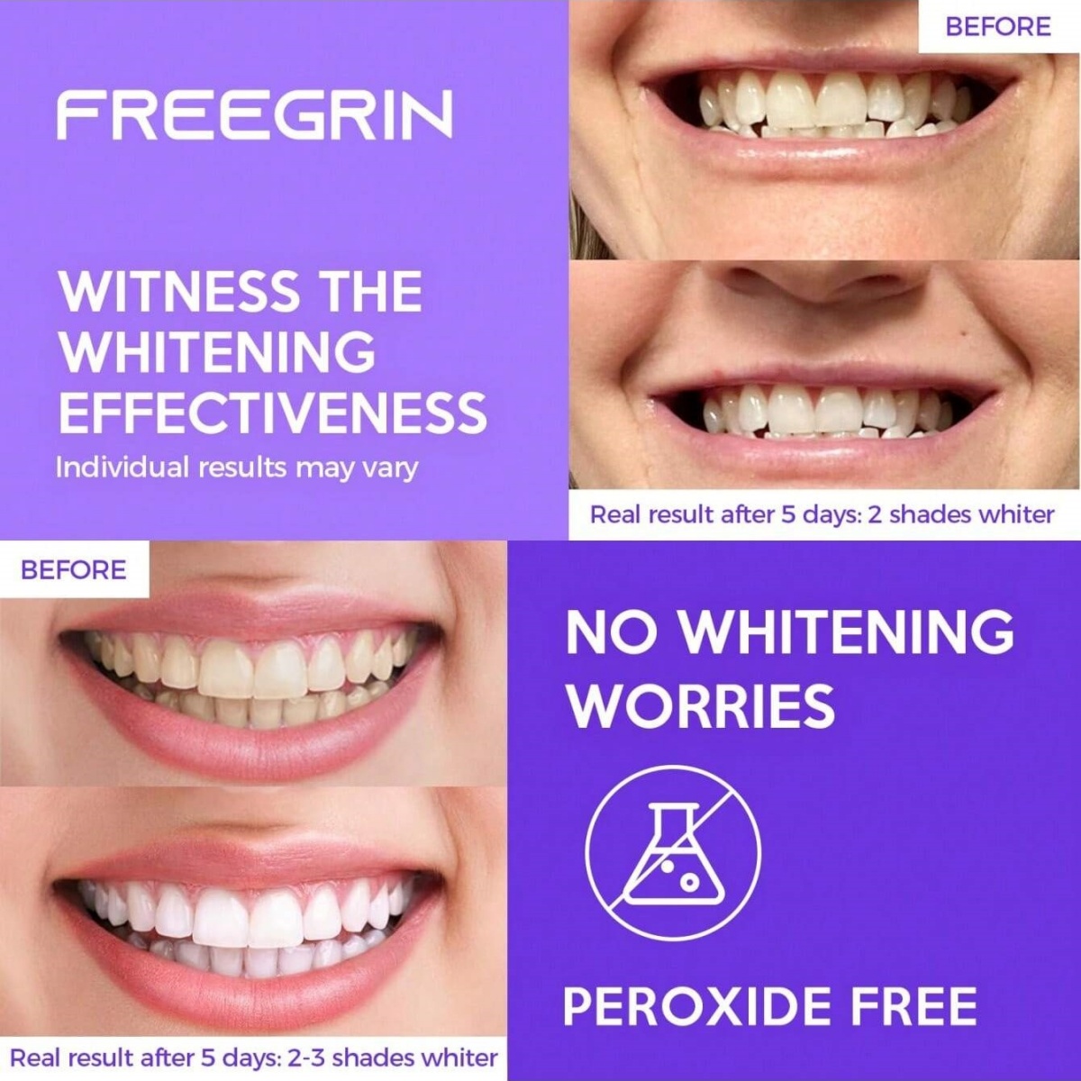 Роскошные отбеливающие наклейк – обзор и цена Teeth Whitening Singapore